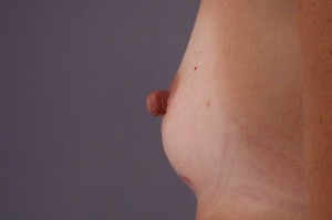 Nipple - Areola Correction