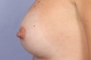 Nipple - Areola Correction