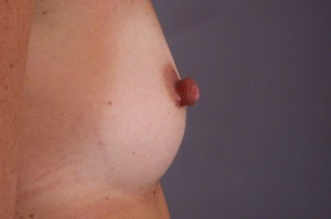 Nipple - Areola Correction