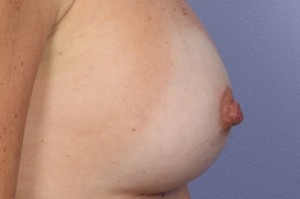 Nipple - Areola Correction