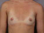 Breast Augmentation