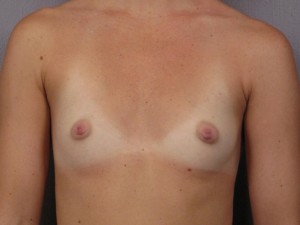 Breast Augmentation