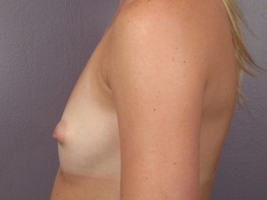 Breast Augmentation