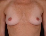 Breast Augmentation