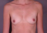 Breast Augmentation