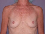 Breast Augmentation