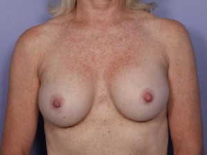 Breast Augmentation