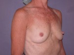 Breast Augmentation