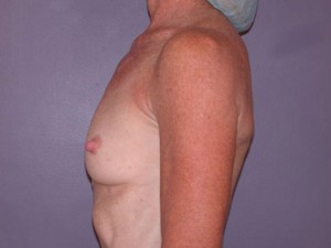 Breast Augmentation