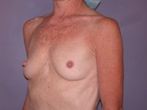 Breast Augmentation