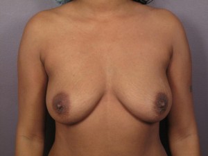 Breast Augmentation