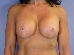 Breast Implant Correction