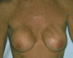 Breast Implant Correction