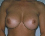 Breast Implant Correction