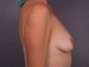 Breast Implant Correction