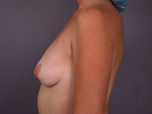 Breast Implant Correction