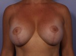 Breast Implant Correction