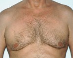 Breast Reduction (for Men)