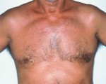 Breast Reduction (for Men)