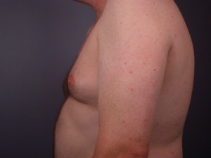 Breast Reduction (for Men)