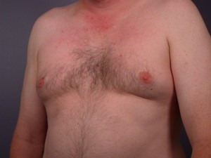 Breast Reduction (for Men)