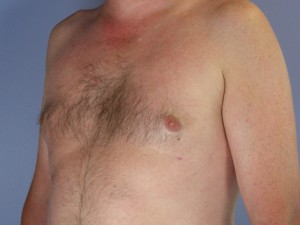 Breast Reduction (for Men)