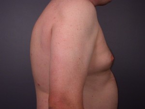 Breast Reduction (for Men)