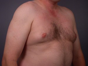 Breast Reduction (for Men)