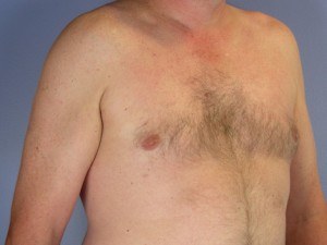 Breast Reduction (for Men)