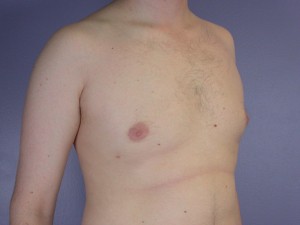 Breast Reduction (for Men)