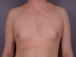 Breast Reduction (for Men)