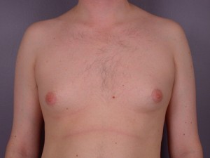 Breast Reduction (for Men)