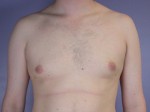 Breast Reduction (for Men)