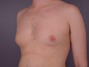 Breast Reduction (for Men)