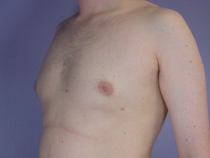 Breast Reduction (for Men)