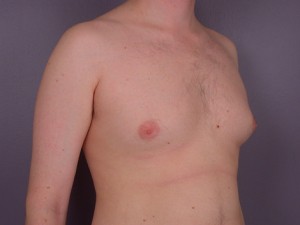 Breast Reduction (for Men)