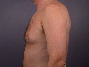 Breast Reduction (for Men)