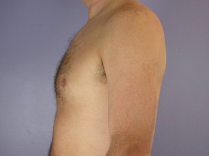 Breast Reduction (for Men)