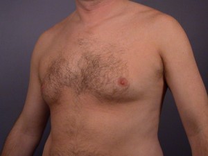 Breast Reduction (for Men)