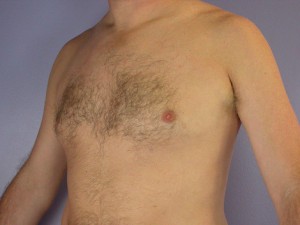 Breast Reduction (for Men)