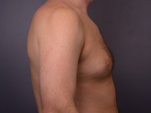 Breast Reduction (for Men)