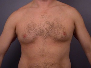 Breast Reduction (for Men)