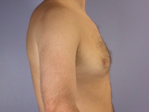 Breast Reduction (for Men)