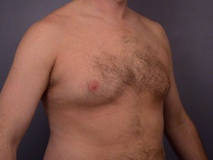 Breast Reduction (for Men)