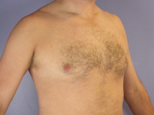 Breast Reduction (for Men)