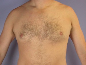 Breast Reduction (for Men)