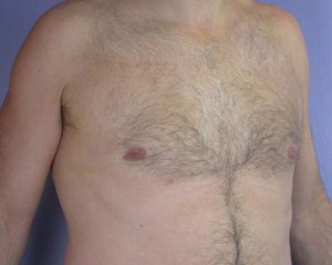 Breast Reduction (for Men)