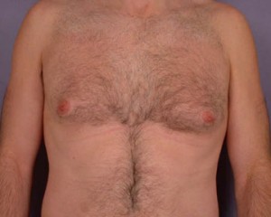 Breast Reduction (for Men)