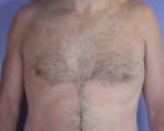 Breast Reduction (for Men)