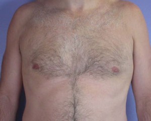 Breast Reduction (for Men)